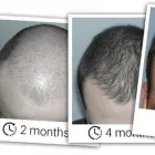 Business 2 image DHI AUSTRALIA Hair Transplant Melbourne in Docklands VIC