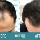 Business 3 image DHI AUSTRALIA Hair Transplant Melbourne in Docklands VIC