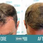 Business 4 image DHI AUSTRALIA Hair Transplant Melbourne in Docklands VIC