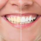 Business 1 image FIFTY SHADES WHITE Dentist in Surfers Paradise QLD