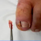 Business 1 image INGROWN TOENAIL CLINICS AUSTRALIA Podiatrist in North Sydney NSW