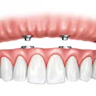 Business 1 image NEPEAN DENTAL IMPLANTS Dentist in Sydney NSW