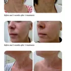 Business 1 image SECOND THOUGHTS TATTOO REMOVAL Tattoo Removal in Kelmscott WA