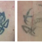 Business 3 image SECOND THOUGHTS TATTOO REMOVAL Tattoo Removal in Kelmscott WA