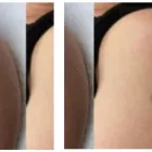 Business 4 image SECOND THOUGHTS TATTOO REMOVAL Tattoo Removal in Kelmscott WA