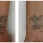 Business 5 image SECOND THOUGHTS TATTOO REMOVAL Tattoo Removal in Kelmscott WA