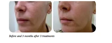 Business 1 image SECOND THOUGHTS TATTOO REMOVAL Tattoo Removal in Kelmscott WA