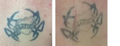 Business 3 image SECOND THOUGHTS TATTOO REMOVAL Tattoo Removal in Kelmscott WA
