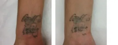 Business 5 image SECOND THOUGHTS TATTOO REMOVAL Tattoo Removal in Kelmscott WA