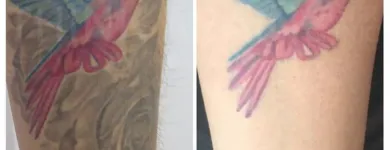 Business 4 image THINK AGAIN LASER CLINIC - BRISBANE Tattoo Removal in Fortitude Valley QLD